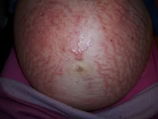 pupp pregnancy rash #10