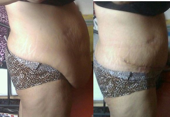 gastric bypass blijven afvallen gastric bypass blijven afvallen